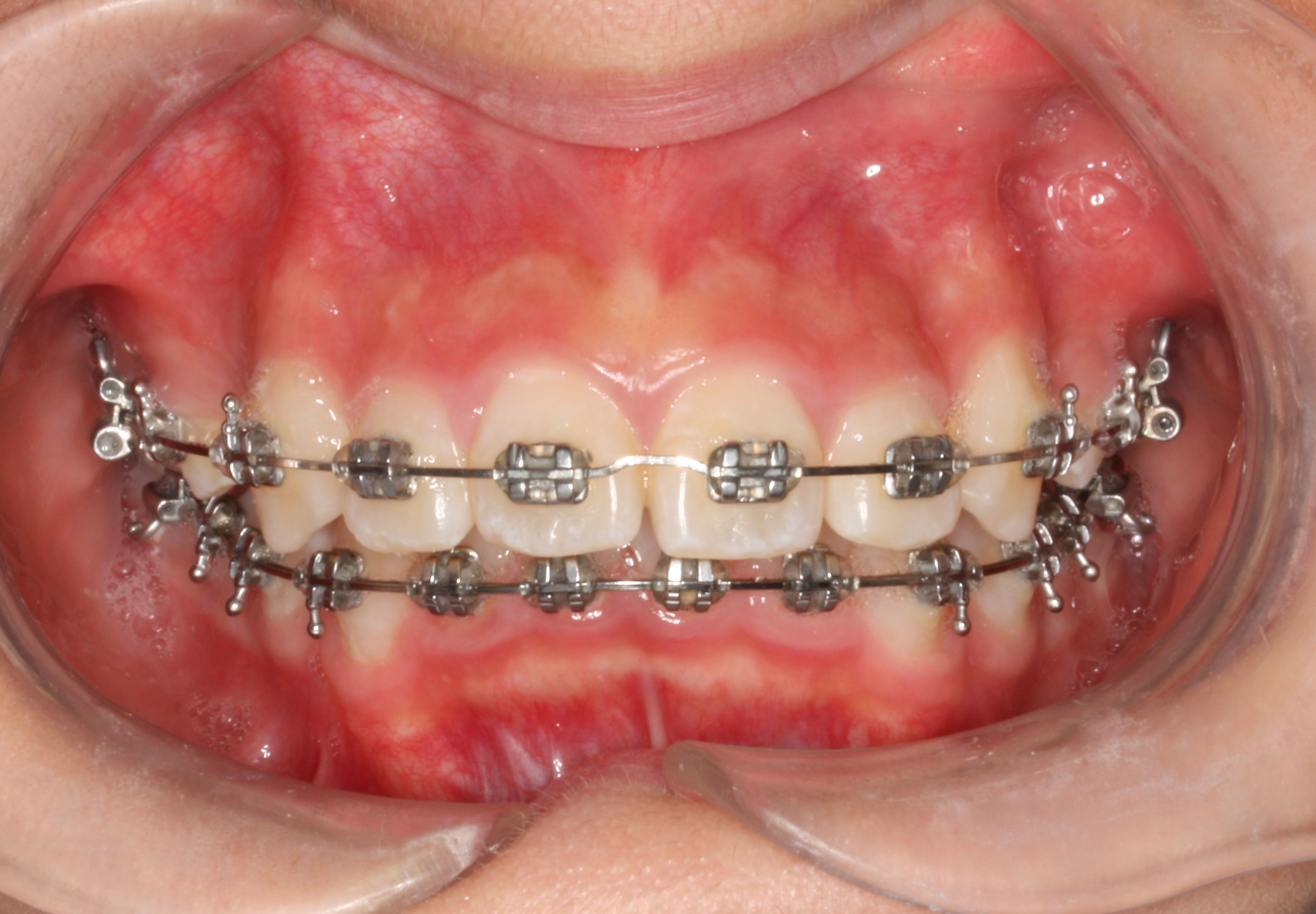 クワドヘリックス 日本橋人形町近く 夜9時までのジェム矯正歯科 中央区の矯正専門 日本橋ジェム矯正歯科ブログ