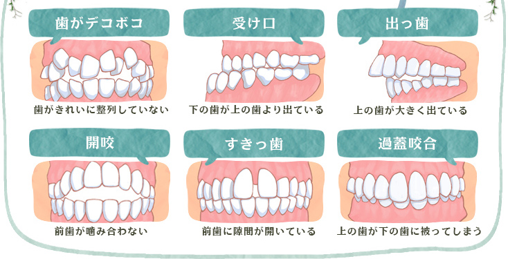 歯がデコボコ 受け口 出っ歯 開咬 すきっ歯 過蓋咬合