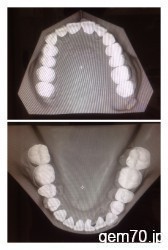 非抜歯