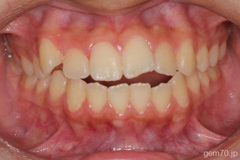 前歯がかみ合わない（開咬）